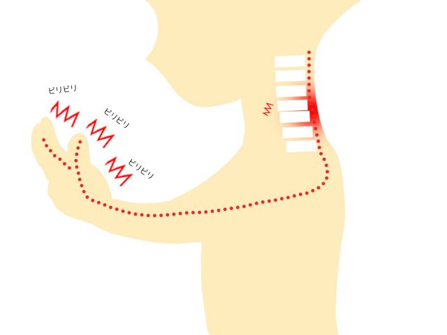 腕や手のシビレ(頸肩腕症候群) 原因　